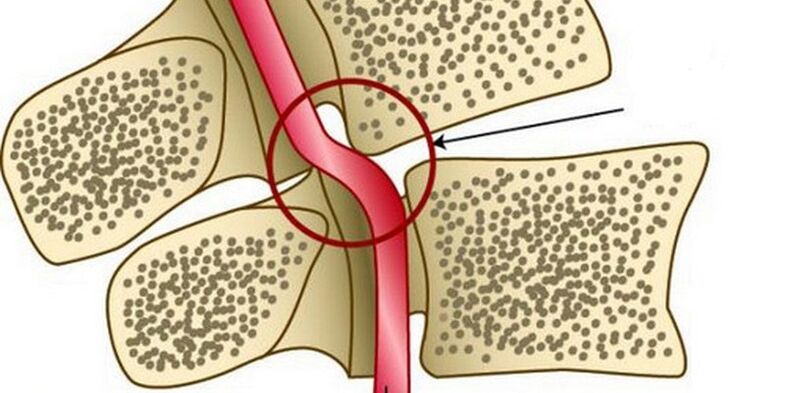 Deformácia vertebrálnej artérie v dôsledku nestability stavcov